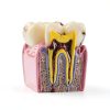 Dental Caries Model Alpha Dental 6x Bilateral Resin Tooth Model-2