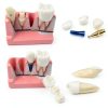 Tangshan Zhengtong Dental Implant Model 4‑Tooth Resin & Metal Kit-5