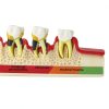 Dentalmall Periodontitis Model 4010 Cross Section Dental Educational-7