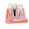 Alpha Dental Resin Metal Implant Crown Bridge Model 4‑Piece Set-4