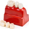 Dental Model QWORK Resin Metal with Magnet Stability Removable Crowns-2