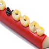 ZITREOXN Soft Skin Periodontitis Dental Model Resin 5‑Stage-4