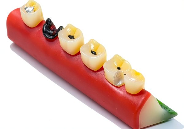 ZITREOXN Soft Skin Periodontitis Dental Model Resin 5‑Stage-4