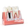 Alpha Dental Resin Metal Implant Crown Bridge Model 4‑Piece Set-3