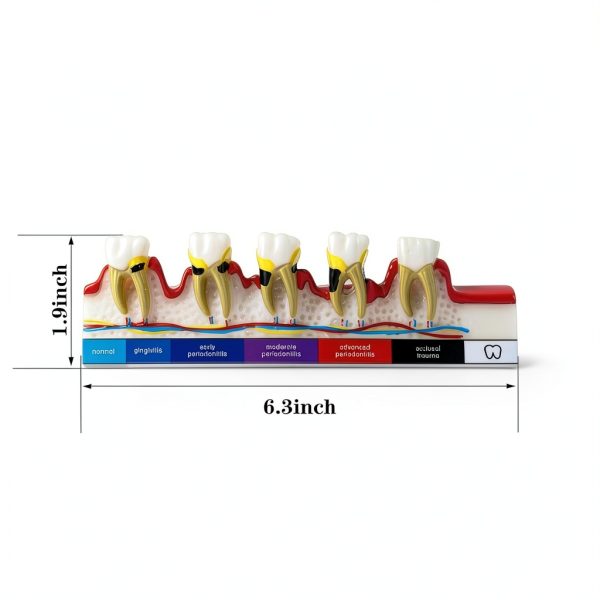 Sprucedent Periodontal Disease Model 6‑Stage Dental Educational Tool-4