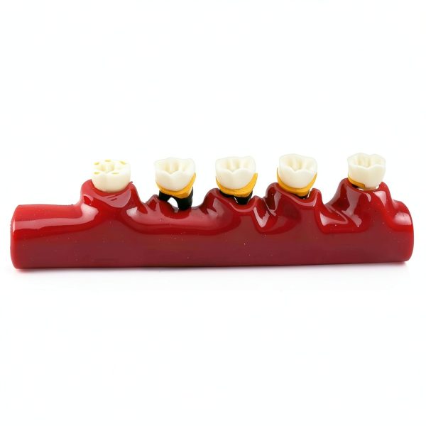 Dentalmall Periodontitis Model 4010 Cross Section Dental Educational-8