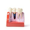 Dental Model QWORK Resin Metal with Magnet Stability Removable Crowns-5