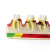 Dentalmall Periodontitis Model 4010 Cross Section Dental Educational-6