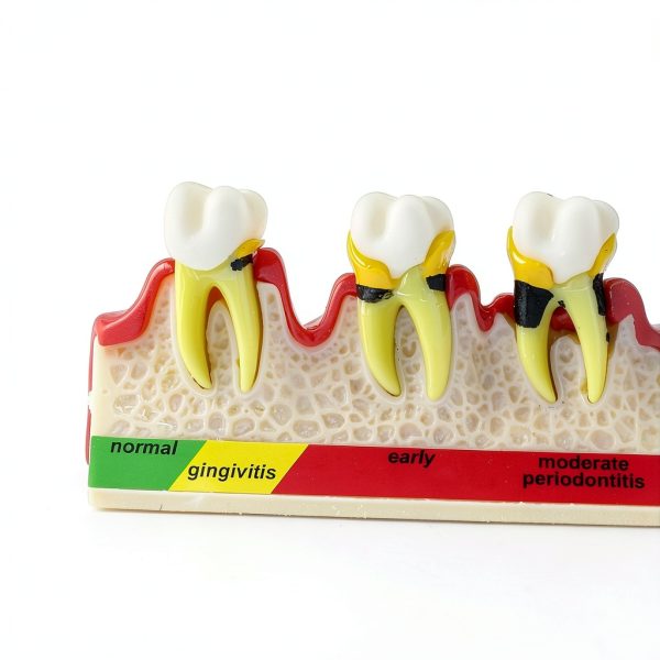 Dentalmall Periodontitis Model 4010 Cross Section Dental Educational-6