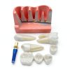 Tangshan Zhengtong Dental Implant Model 4‑Tooth Resin & Metal Kit-2
