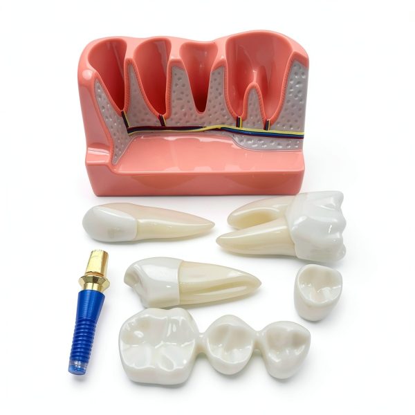 Tangshan Zhengtong Dental Implant Model 4‑Tooth Resin & Metal Kit-2