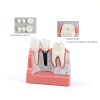 Alpha Dental Resin Metal Implant Crown Bridge Model 4‑Piece Set-1
