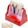 Dental Model QWORK Resin Metal with Magnet Stability Removable Crowns-7