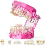 Outus Pink Dental Pathology Tooth Model 2.76" x 2.48" Size 1-0