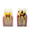 Dental Caries Model Alpha Dental 6x Bilateral Resin Tooth Model-1
