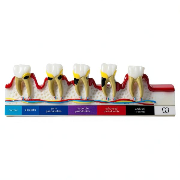 Sprucedent Periodontal Disease Model 6‑Stage Dental Educational Tool-0