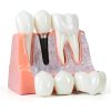 Alpha Dental Resin Metal Implant Crown Bridge Model 4‑Piece Set-0