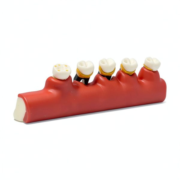 Dentalmall Periodontitis Model 4010 Cross Section Dental Educational-4