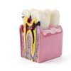 Dental Caries Model Alpha Dental 6x Bilateral Resin Tooth Model-3