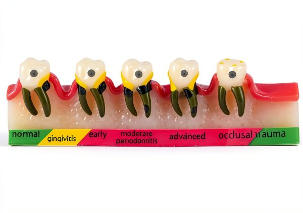 ZITREOXN Soft Skin Periodontitis Dental Model Resin 5‑Stage-1