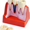 Dental Model QWORK Resin Metal with Magnet Stability Removable Crowns-0