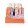 Dental Model QWORK Resin Metal with Magnet Stability Removable Crowns-6