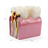 Dental Caries Model Alpha Dental 6x Bilateral Resin Tooth Model-4