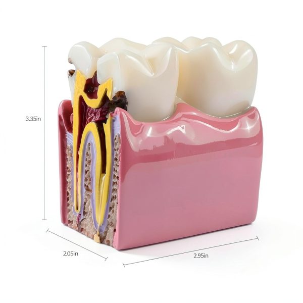 Dental Caries Model Alpha Dental 6x Bilateral Resin Tooth Model-4
