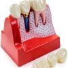 Dental Model QWORK Resin Metal with Magnet Stability Removable Crowns-1