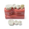 Tangshan Zhengtong Dental Implant Model 4‑Tooth Resin & Metal Kit-4