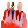 Dental Model QWORK Resin Metal with Magnet Stability Removable Crowns-3