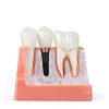 Alpha Dental Resin Metal Implant Crown Bridge Model 4‑Piece Set-2