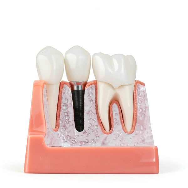 Alpha Dental Resin Metal Implant Crown Bridge Model 4‑Piece Set-2