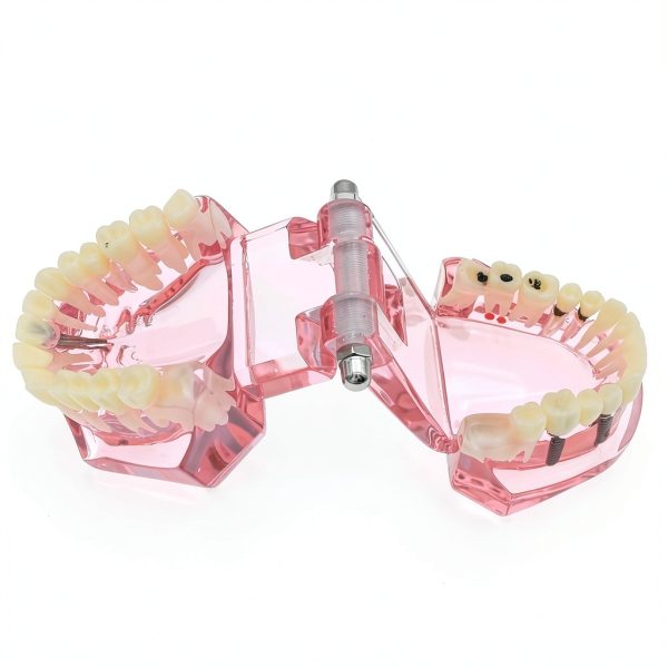 Dental Implant Model 2001P by XINGXING Fixed Prosthetic Demo Kit-4