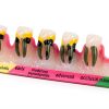 ZITREOXN Soft Skin Periodontitis Dental Model Resin 5‑Stage-0