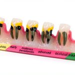 ZITREOXN Soft Skin Periodontitis Dental Model Resin 5‑Stage-0