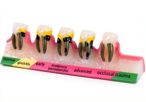 ZITREOXN Soft Skin Periodontitis Dental Model Resin 5‑Stage-0